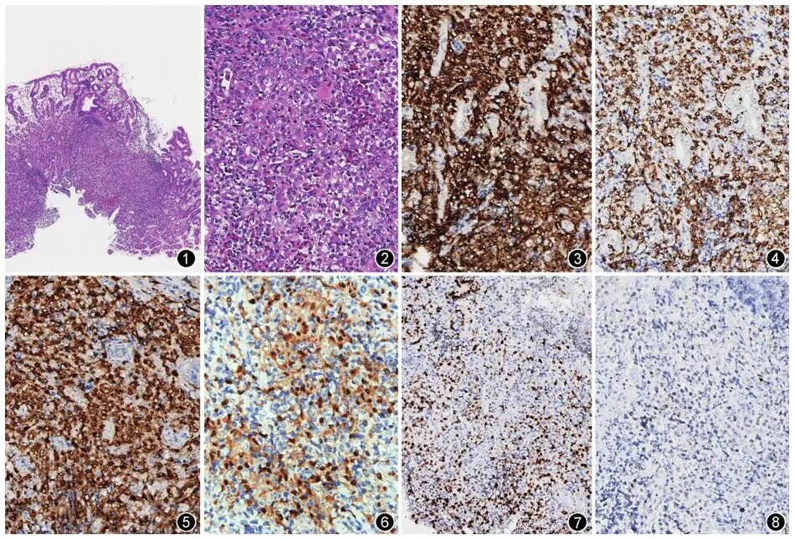 SpaceGen sequencing service facilitates research regarding the treatment of adult gastric isolated Langerhans cell histi